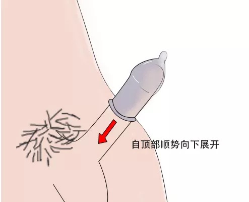 08  安全套应在勃起的阴茎上自顶部顺势向下展开，而不是提前展开。