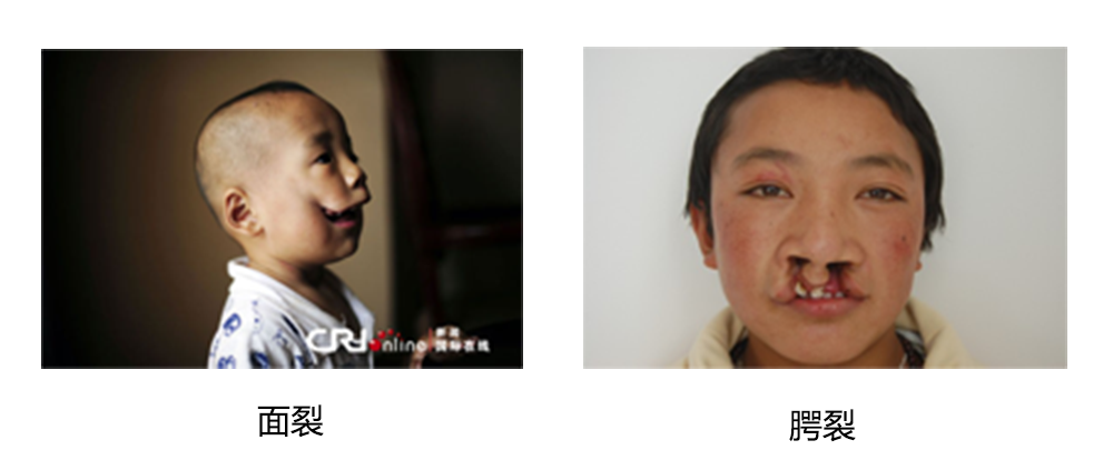 一例神经管缺损病例（骶骨发育不全，脊髓脊膜膨出和脑积水），一例双侧面裂，眼球缺血和羊膜带综合征