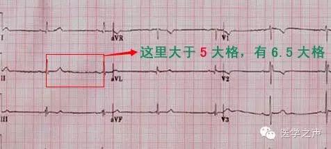 窦性心动过缓=大于五格