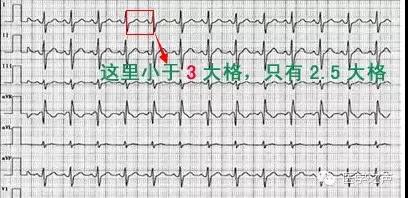 窦性心动过速=小于三格