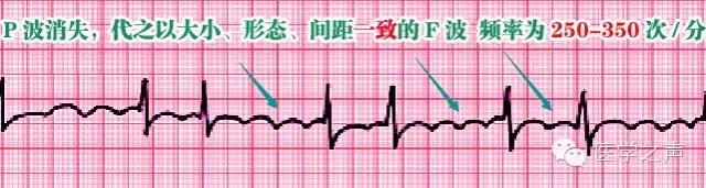 心房扑动