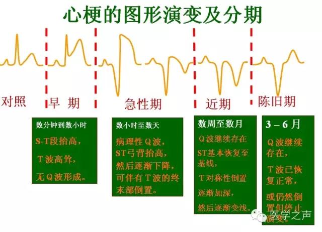 心梗的图形演变及分期