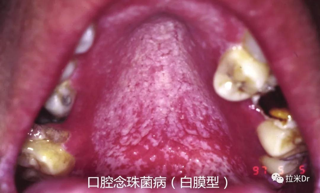 口腔念珠菌病 口腔念珠菌病