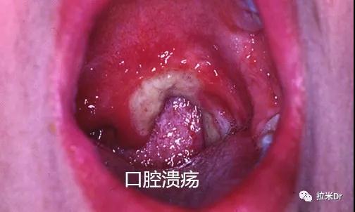 复发性阿弗他溃疡 复发性阿弗他溃疡