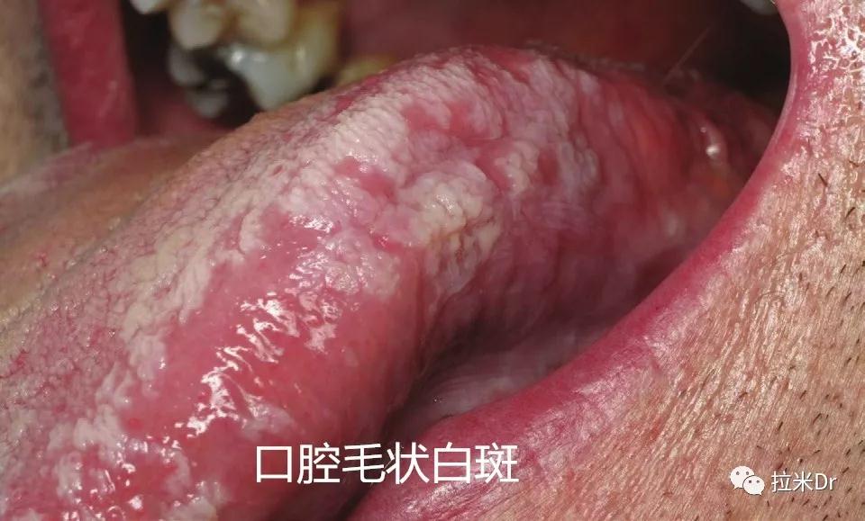 口腔毛状白斑 口腔毛状白斑