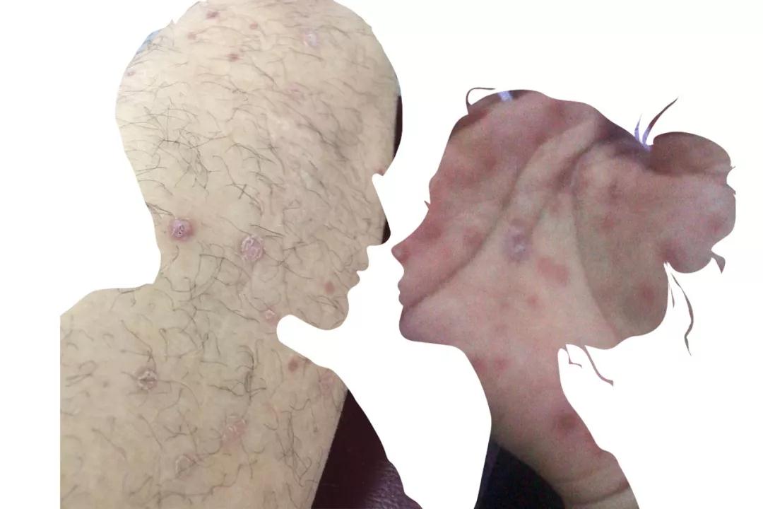 梅毒感染者