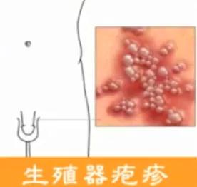 生殖器疱疹
