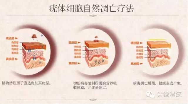 疣体细胞自然凋亡疗法
