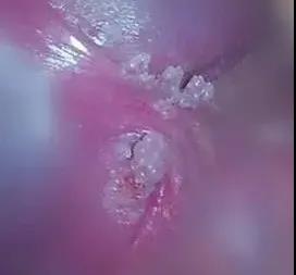 长在龟头的尖锐湿疣